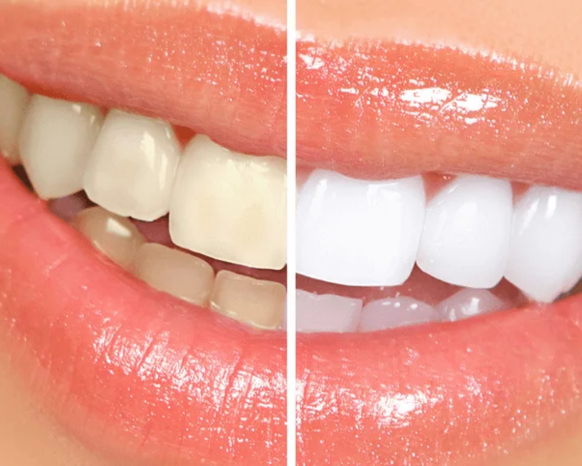 تبييض الأسنان (Zoom)