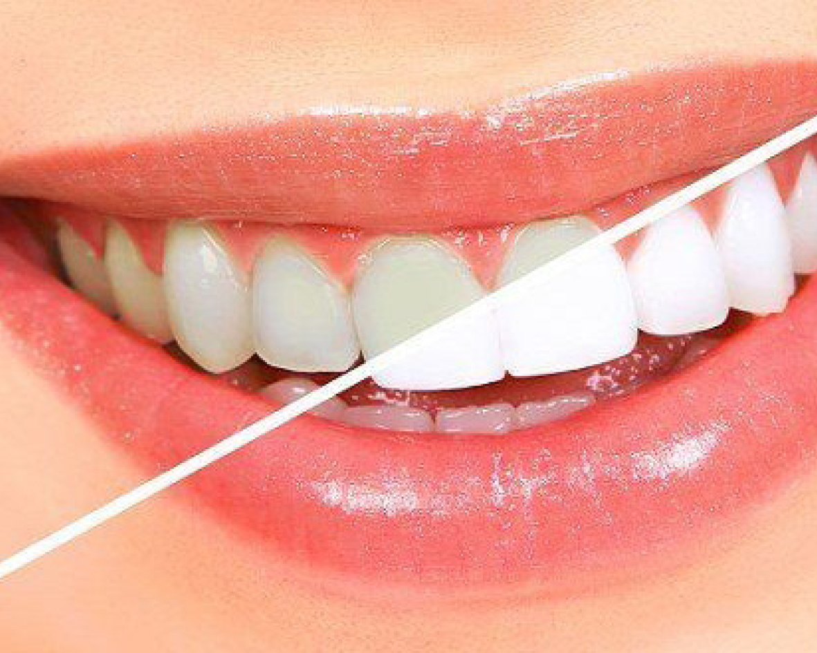 تبييض الأسنان