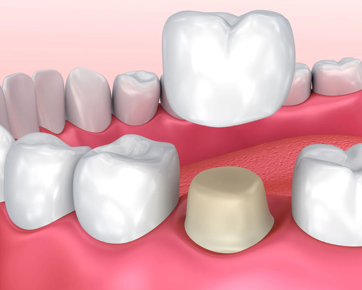 تيجان وجسور