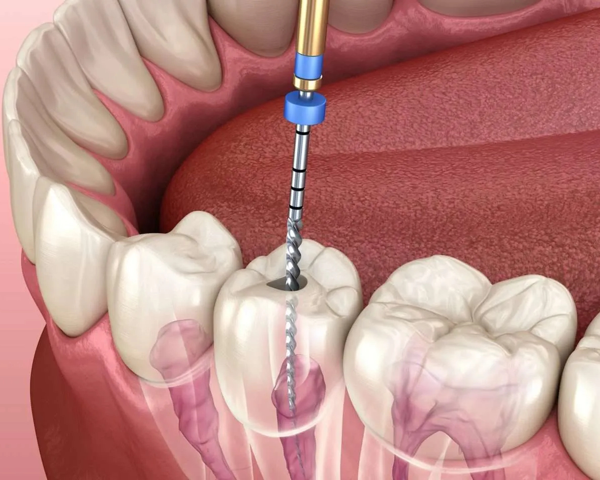 حشوات العصب