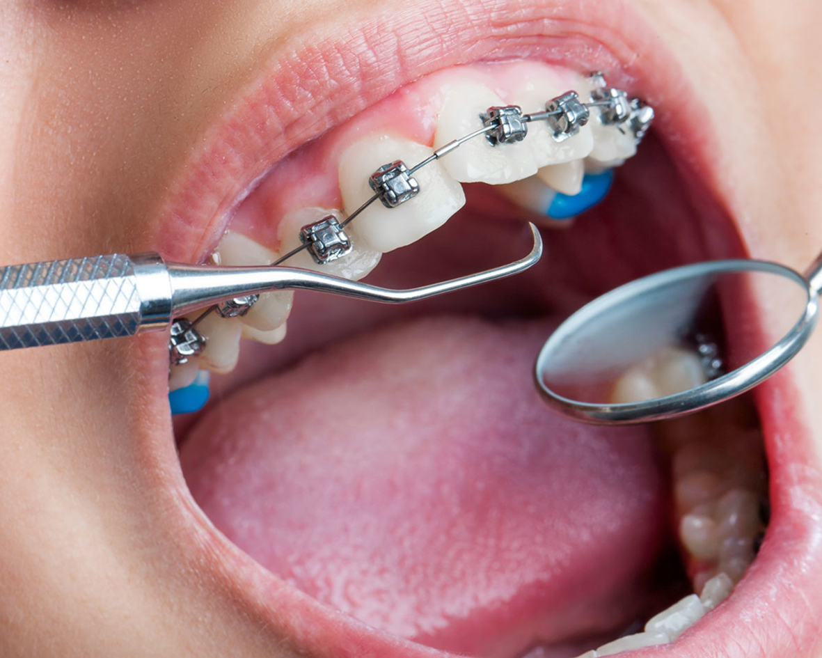 معالجة الأسنان