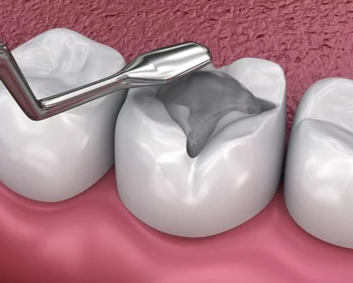 حشوات الأسنان